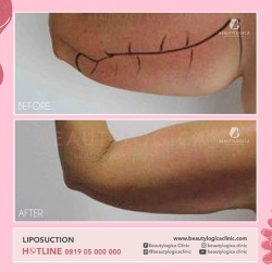 LIPOSUCTION-02