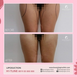 LIPOSUCTION-04