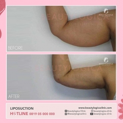 LIPOSUCTION-05