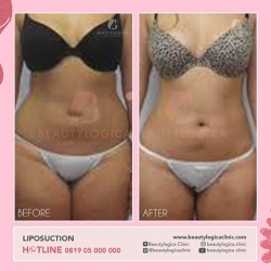LIPOSUCTION-09