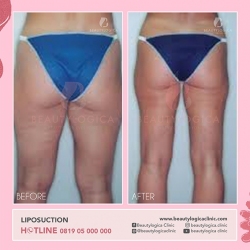 LIPOSUCTION-10