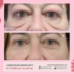 LOWER-BLEPHAROPLASTY-01
