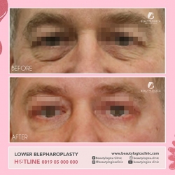 LOWER-BLEPHAROPLASTY-02