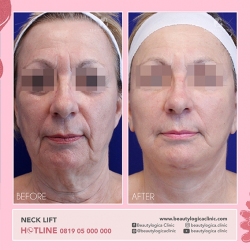 NECK-LIFT-01