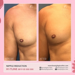 NIPPLE-REDUCTION-01