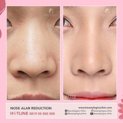 NOSE-ALAR-REDUCTION-01