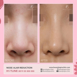 NOSE-ALAR-REDUCTION-02