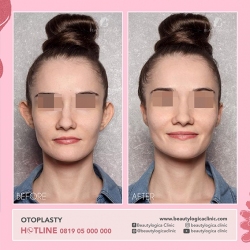 OTOPLASTY-01
