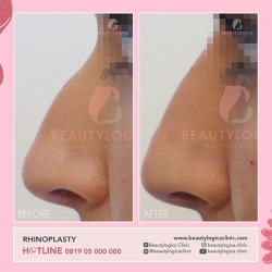 RHINOPLASTY-01