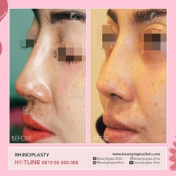 RHINOPLASTY-02