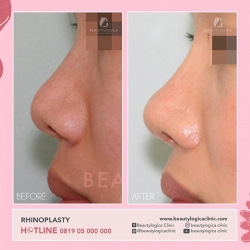 RHINOPLASTY-03