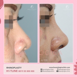 RHINOPLASTY-04
