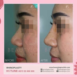 RHINOPLASTY-05