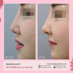 RHINOPLASTY-06