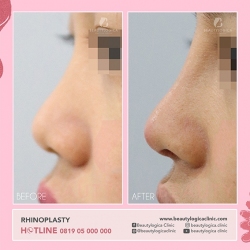 RHINOPLASTY-07