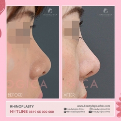 RHINOPLASTY-08