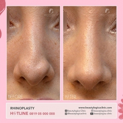 RHINOPLASTY-09