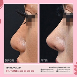 RHINOPLASTY-11