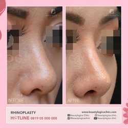 RHINOPLASTY-12
