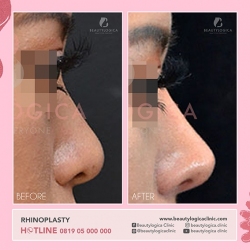 RHINOPLASTY-13