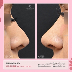 RHINOPLASTY-14