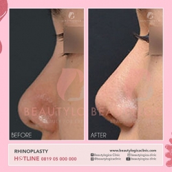 RHINOPLASTY-15