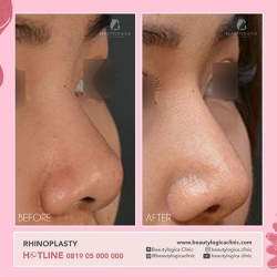 RHINOPLASTY-16