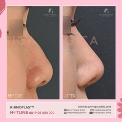 RHINOPLASTY-17