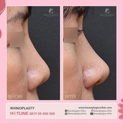RHINOPLASTY-18