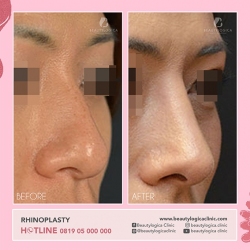 RHINOPLASTY-19