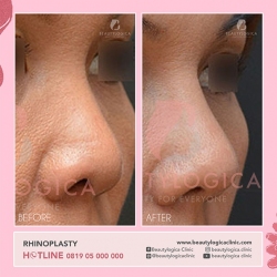 RHINOPLASTY-21
