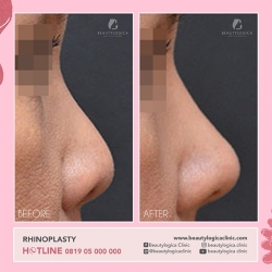 RHINOPLASTY-22