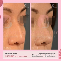 RHINOPLASTY-23