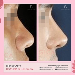 RHINOPLASTY-24
