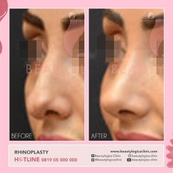 RHINOPLASTY-25