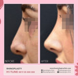 RHINOPLASTY-26
