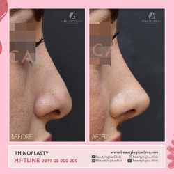 RHINOPLASTY-27