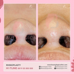RHINOPLASTY-28