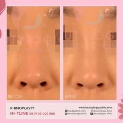 RHINOPLASTY-29