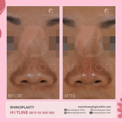 RHINOPLASTY-30