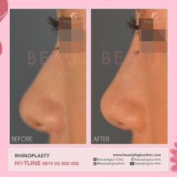 RHINOPLASTY-31