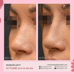 RHINOPLASTY-32