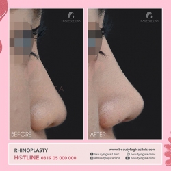 RHINOPLASTY-33