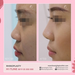 RHINOPLASTY-34