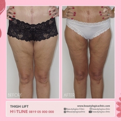 THIGH-LIFT-01