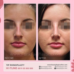 TIP-RHINOPLASTY-01