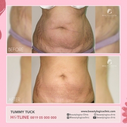 TUMMY-TUCK-01