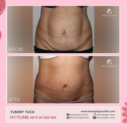 TUMMY-TUCK-02