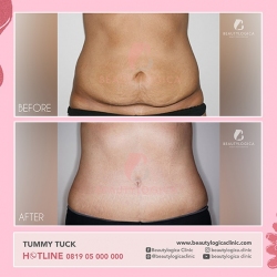 TUMMY-TUCK-03