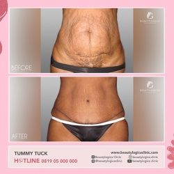 TUMMY-TUCK-04